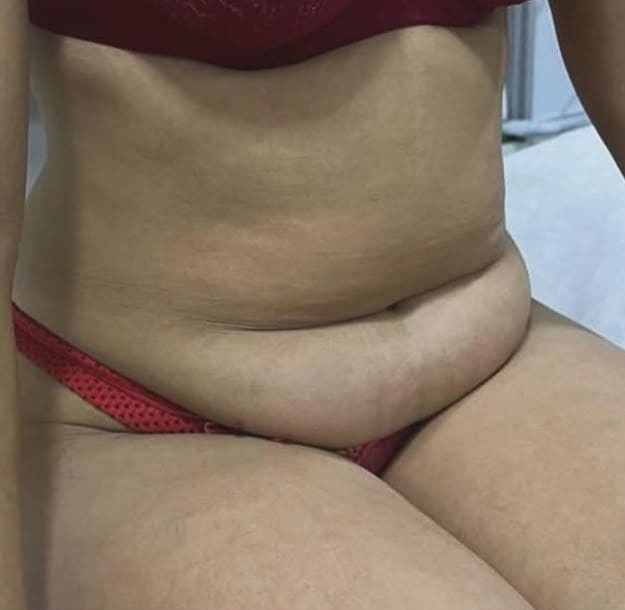 Antes — Abdominoplastia