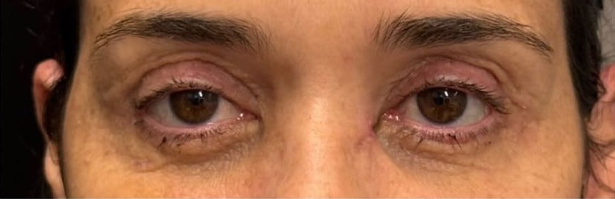 Depois — Blefaroplastia