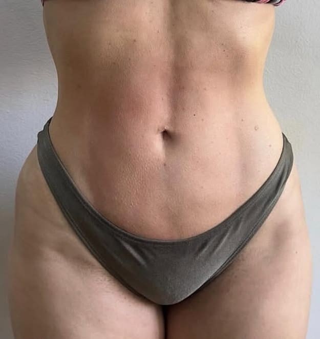Depois — Lipoaspiração